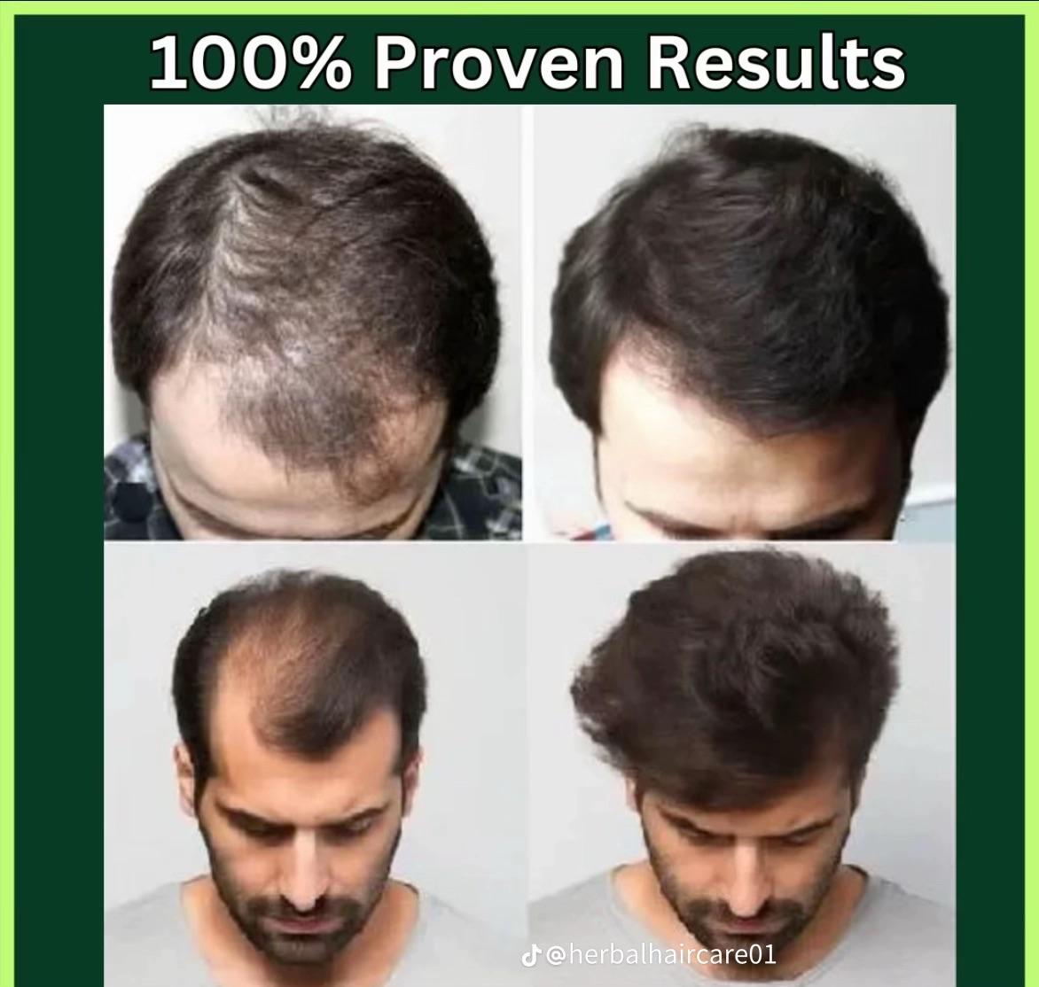 Adivasi Secret™ Orignal Herbal Hair Oil 100ml